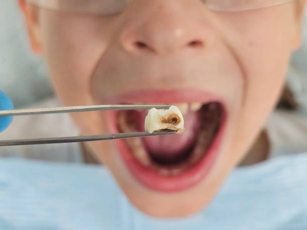 Best Emergency Dentist for Lost Fillings or Crowns in Lake San Marcos, CA